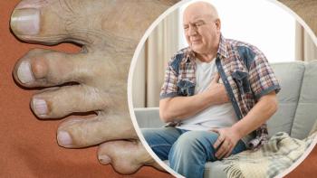 New Data Demonstrates Link Between Gout and Cardiovascular Disease