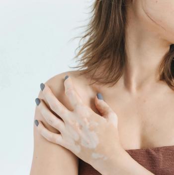 Coping Methods, Lack of Support Are Predictors of Self-Stigma for Patients with Skin Disease