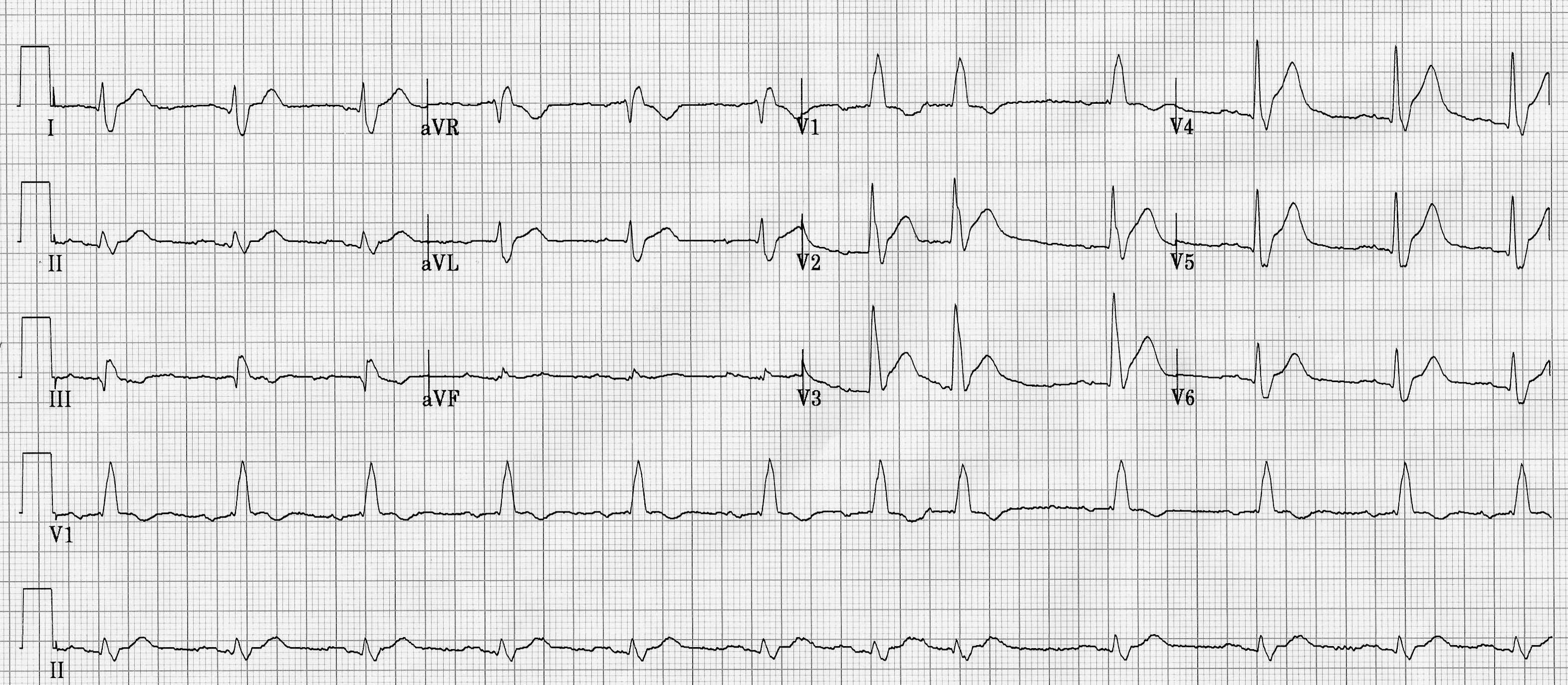 EKG printout featured in case report.
