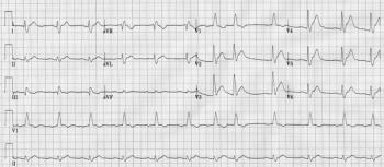 EKG printout featured in case report.