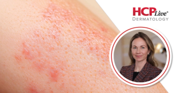 What Are the Key Signs of UV Damage to Look For? With Kathleen Suozzi, MD