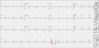 Visual Dx:  Syncope, Seizure and Hypokalemia ...Can You Diagnose This Patient? 