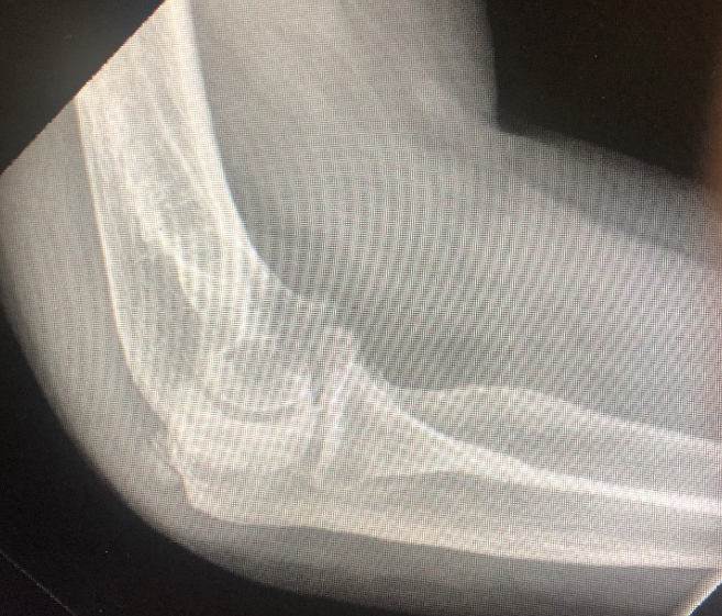 X-ray image of a person's elbow