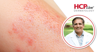Spotlighting Data on Clearance of Actinic Keratosis Using Tirbanibulin, With Neal Bhatia, MD