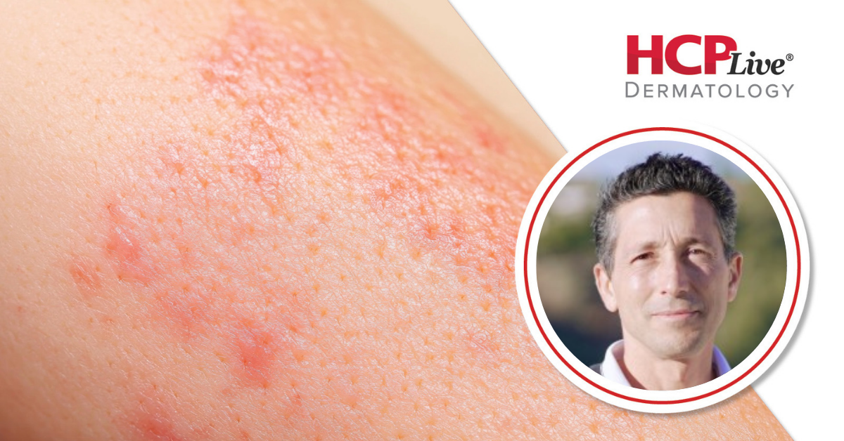 Key Insights on Upadacitinib’s Efficacy for Non-Segmental Vitiligo, With Thierry Passeron, MD, PhD