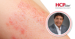 Sequencing Emerging Therapies in CSU, With Jonathan Bernstein, MD