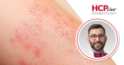 Contact Dermatitis Updates for 2026, With Walter Liszewski, MD