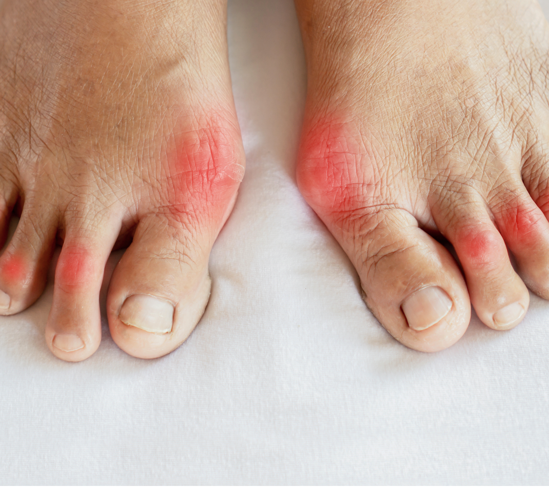 Pegloticase and Methotrexate Co-Therapy Improved Urate Burden, Patient-Reported Outcomes in Gout