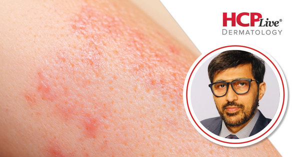 Q&A: Where is Vitiligo Headed in 2026? With Davinder Parsad, MD