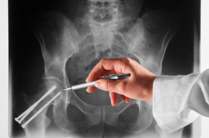 Doctor examining a hip x-ray