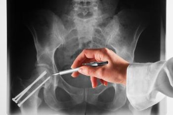 Doctor examining a hip x-ray