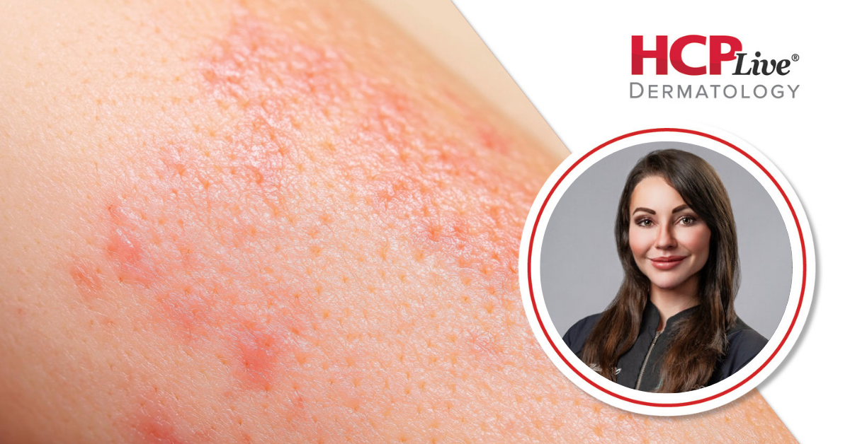 Off-Label JAK Inhibitors and New Drugs in the Dermatology Pipeline, With Gabriela Maloney, DO