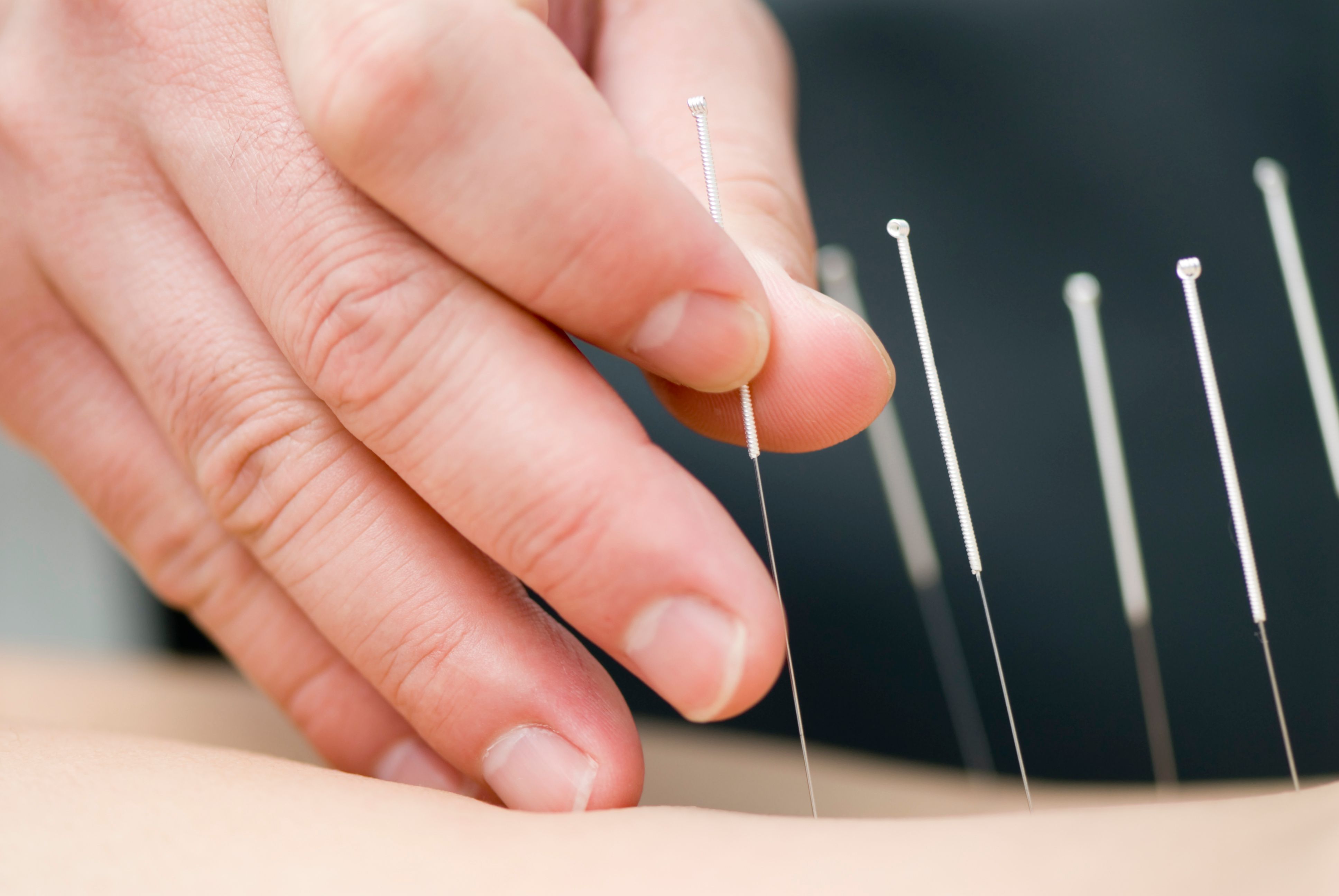 Acupuncture Pain Management in Ann Arbor, MI