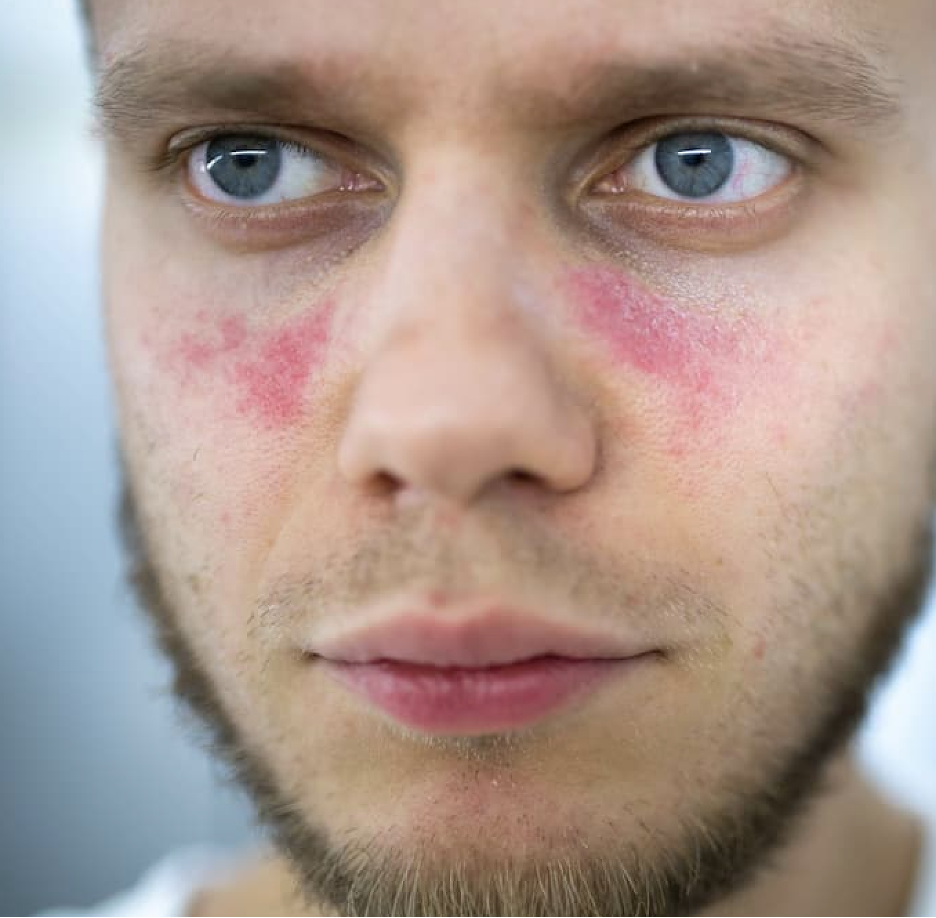 Phase 2 Trial Reaches Primary Endpoint for Upadacitinib Treatment in ...