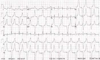 ECG from a patient presenting to the hospital
