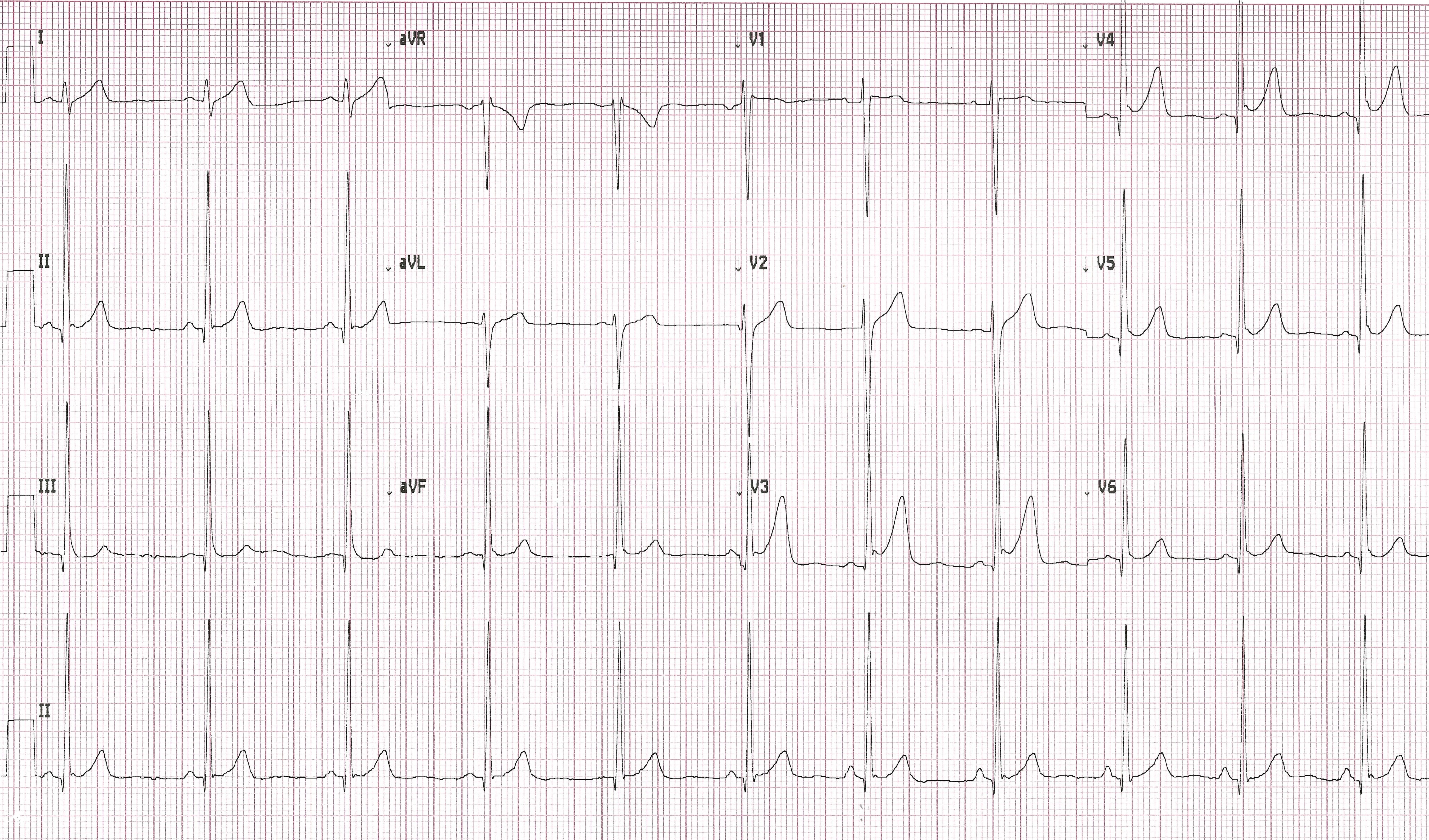 ECG Printout from patient featured in case report. | Credit: Brady Pregerson, MD