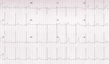 ECG Printout from patient featured in case report. | Credit: Brady Pregerson, MD