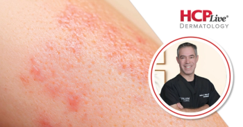 Why Dermatologists Should Add Serum Tryptase to the Workup for Chronic Itch