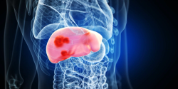 Non-Invasive Tests Predict Liver Cancer Risk in Hepatitis C Patients After SVR