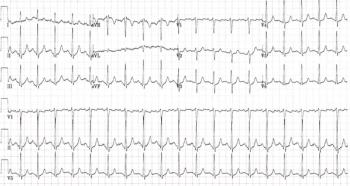 ECG reading
