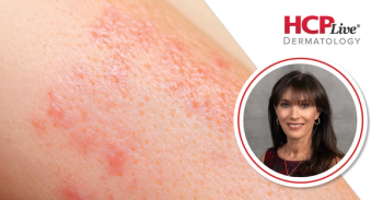 Discussing Icotrokinra’s Performance Versus Deucravacitinib in Psoriasis, With Linda Stein Gold, MD