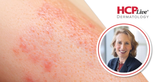 VELA: Phase 3 Data Suggest Sonelokimab Effective for HS, With Alexa Kimball, MD, MPH