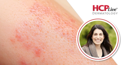 Q&A: Eczema Awareness Month-The Mind-Skin Connection, With Keira Barr, MD