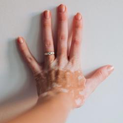 Vitiligo Patients Face Higher All-Cause, Vitiligo-Related Costs Compared to Those Without