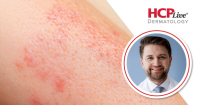 Q&A: How Trial Enrichment Shaped APEX's Radiographic Findings in Psoriatic Disease