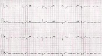 ECG print out from a patient experiencing chest pain