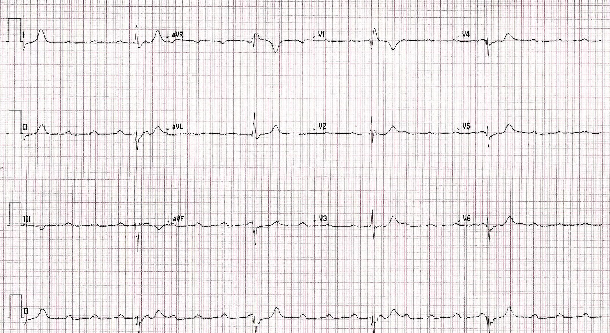 Cardiology Case Report Chest Pain And Syncope cardiology-case-report-chest-pain-and-syncope