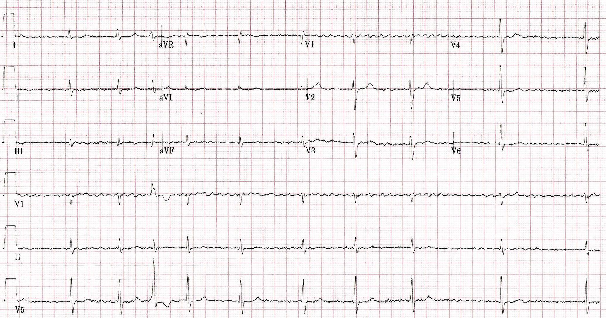 EKG strip of a patient with atrial fibrillation.