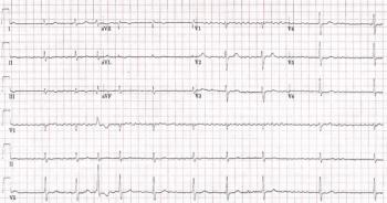 EKG strip of a patient with atrial fibrillation.