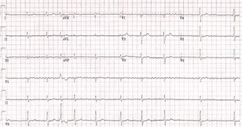 EKG strip of a patient with atrial fibrillation.