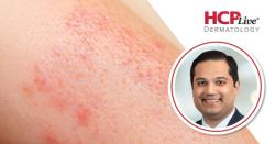 REZOLVE-AD: Rezpegaldesleukin Shows Consistent Efficacy Across Atopic Dermatitis Severity, With Raj Chovatiya, MD, PhD