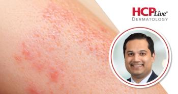 REZOLVE-AD: Rezpegaldesleukin Shows Consistent Efficacy Across Atopic Dermatitis Severity, With Raj Chovatiya, MD, PhD