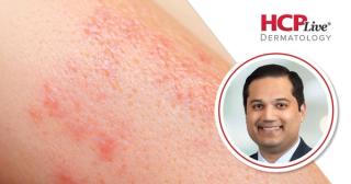 REZOLVE-AD: Rezpegaldesleukin Shows Consistent Efficacy Across Atopic Dermatitis Severity, With Raj Chovatiya, MD, PhD