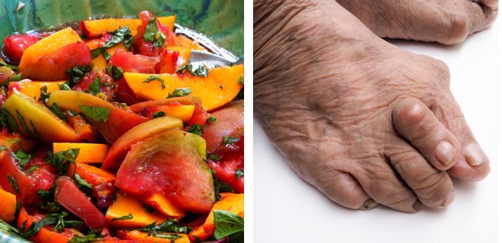 Diet Has a Limited Role in Managing Gout