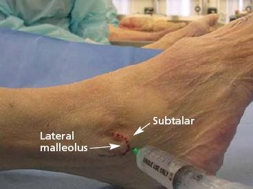 Injection of the subtalar joint and sinus tarsi