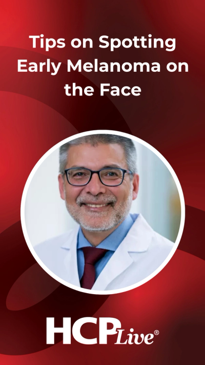 Tips on Spotting Early Melanoma on the Face