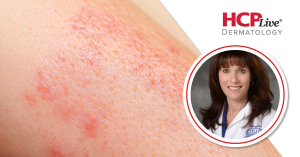 Age-Stratified Phase 3 Data Support Tapinarof Cream in Pediatric Eczema