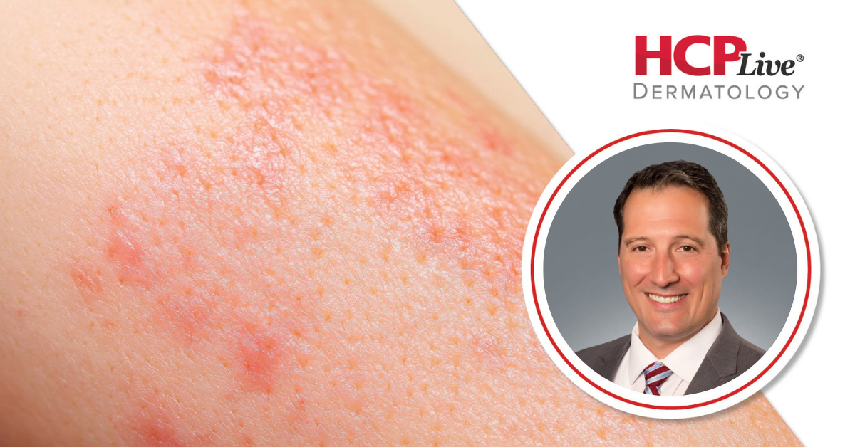 Are Catalytic Converters and Polyester Clothing Impacting Eczema Rates?