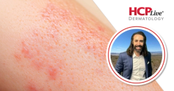 Positive Results Identified for Risankizumab and Other Psoriasis Drugs, With David Cotter, MD, PhD