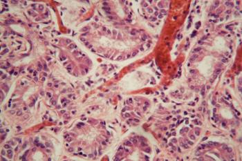 Human lung tissue with Pulmonary embolism under a microscope.
