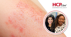 World Psoriasis Day: Advocates Offer Tips for Culturally Competent Care