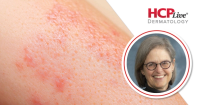 Key Clinical Practice Pearls in Atopic Dermatitis, With Elaine Siegfried, MD