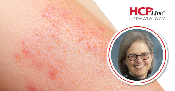 Key Clinical Practice Pearls in Atopic Dermatitis, With Elaine Siegfried, MD