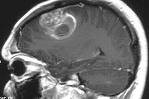 Altitude Sickness Drug May Help Glioblastoma Patients