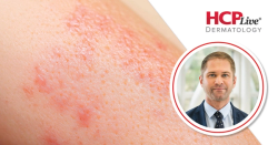 Management of Cutaneous Adverse Events in Oncodermatology, With Drew Kuraitis, MD, PhD