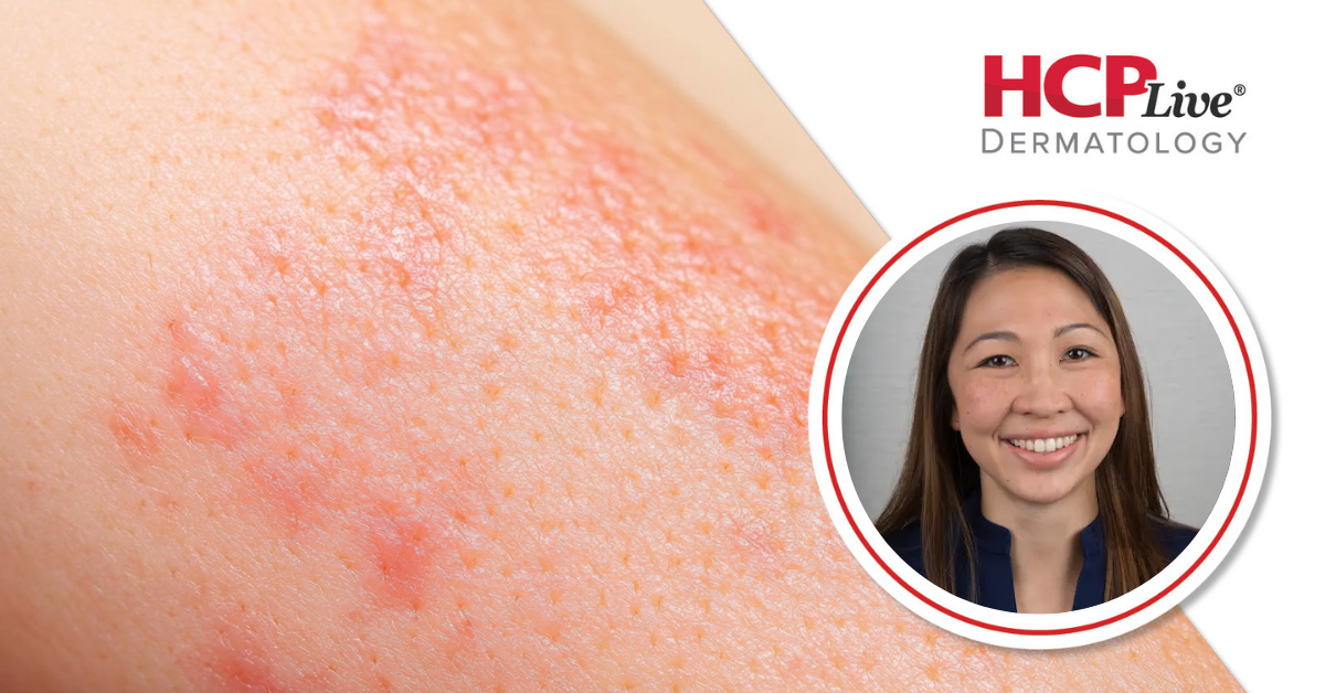 Povorcitinib Efficacy Holds in Biologic-Experienced HS, With Martina ...